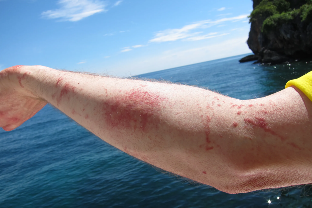 close up of an arm with red inflammation and scars from sting of a box jellyfish